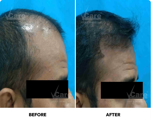 Graft-implantation-process